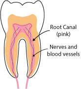 What is a root canal