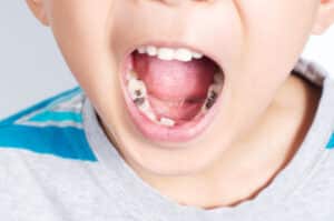 how much do fillings cost